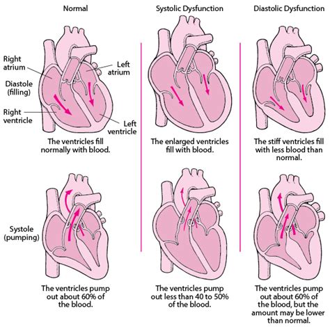 left ventricle not pumping properly